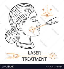 Laser Bleaching Treatment